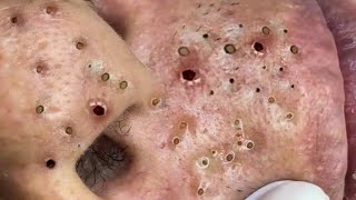 Big Cystic Acne Blackheads Extraction Blackheads amp Milia Whiteheads Removal Pimple Popping  3720 [upl. by Tehc]