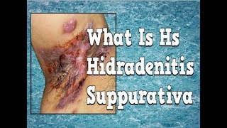 What Is Hs How To Get Rid Of Hidradenitis Suppurativa Hidradenitis Suppurativa Treatment Options [upl. by Etaner685]