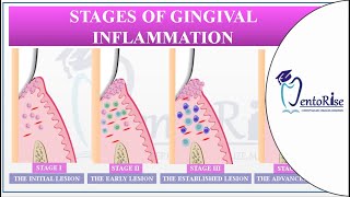 Gingivitis  STAGES OF GINGIVAL INFLAMMATION  Gum disease Carranza Periodontology [upl. by Welch]