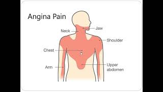 Angina Equivalent Dr Akif Baig [upl. by Edylc]