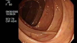 Colonoscopy Demonstrating a Moving Worm  NEJM [upl. by Laertnom61]