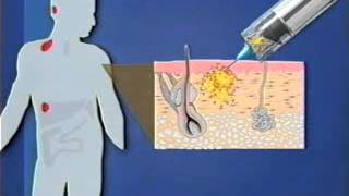 How Does a Dendritic Cell Vaccine Work [upl. by Kenison]