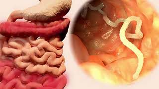 How to Get Rid of Intestinal Parasites recipe  Home Remedies [upl. by Lamp607]