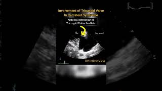 Involvement of Tricuspid Valve in Carcinoid Syndrome echocardiography [upl. by Floro617]