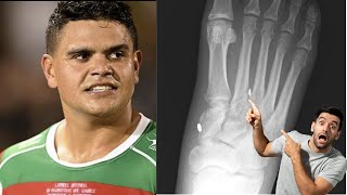 Latrell Mitchell LISFRANC FOOT INJURY Explained Will he need SURGERY [upl. by Keare]