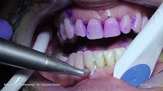 PROPHYLAXIS  Dr Giacomo Oldoini  Periodontal Mantainance [upl. by Inavoj]