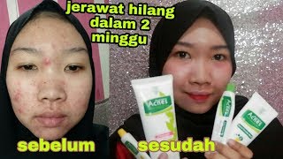 REVIEW JUJUR ACNES TREATMENT SERIES SKINCARE UNTUK MUKA BERJERAWAT acnes [upl. by Gagne463]