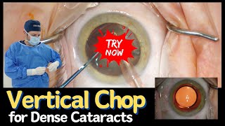 Vertical Chop  A Technique for Dense Cataracts [upl. by Tnilk814]