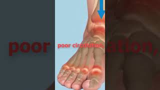 The shocking cause of ankle swelling  causes of edema  swollen feet  edema swollen ankles [upl. by Ikcin727]