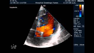 Miocardiopatia No compactada en varon de 43 anos Dr Pedro Guillermo Bustos [upl. by Rusticus]