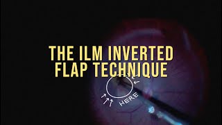 The ILM inverted flap technique for macular hole repair [upl. by Kaehpos]