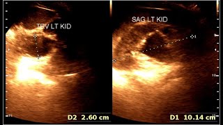 Primary bladder neck obstruction PBNO  Bladder outlet obstruction BOO  Hydro nephrosis [upl. by Yeldud]