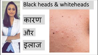 blackheads whiteheads treatment  ब्लाक हेड्ज़ को कैसे निकाले  त्वचा के डॉक्टर [upl. by Donaghue]