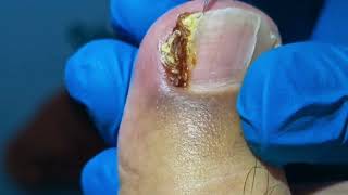 Infected Ingrown Toenail RUINS Toes Overnight [upl. by Drofiar]