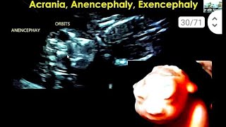 anencephaly 16 सप्ताह के बच्चे का हेडब्रेन brain 🧠 का नही बनना [upl. by Inalak700]