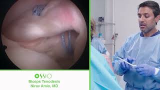 Nirav Amin MD Biceps Tenodesis procedure using OSSIOfiber® [upl. by Dubenko]