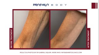 Profhilo Body arms by Dr Gabriel Siquier [upl. by Klaus297]