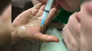 Trigger Finger Treatment Corticosteroid Injection [upl. by Phia266]