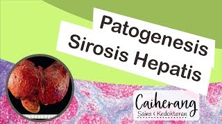 Definisi dan Patogenesis Sirosis Hati  Sirosis Hepatis [upl. by Fanchan]