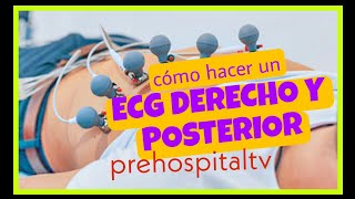 ⚠️✅️ ♥️ Derivaciones DERECHAS y POSTERIORES en ECG ♥️✅️⚠️ [upl. by Doraj211]