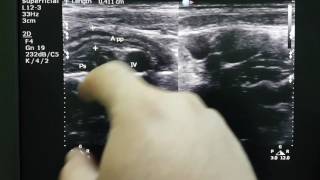 Mesenteric Lymphadenitis Sonography [upl. by Anwadal]