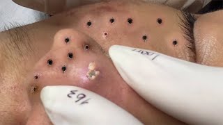 Big Cystic Acne Blackheads Extraction Blackheads amp Milia Whiteheads Removal Pimple Popping  4663 [upl. by Tychon]