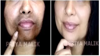 Remove Dark Black patches Dark Spots Around Your Mouth Get Rid Of Hyper Pigmentation  Priya Malik [upl. by Terencio361]