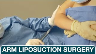 Arm Liposuction Surgery Demonstration  Khalifeh Plastic Surgery [upl. by Ylecic952]