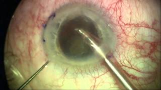 Cataract Surgery with a Limbal Relaxing Incision LRI to Correct Astigmatism [upl. by Kciwdahc266]