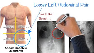 Pain in lower left abdomen  Low Stomach Pain Most Common Causes [upl. by Ullyot]