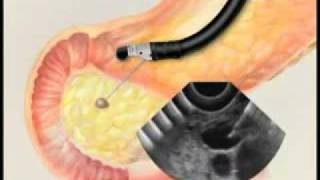 Endoscopic Ultrasound with Fine Needle Aspiration Biopsymp4 [upl. by Emirej956]