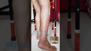 Right bow leg CORRECTION [upl. by Anilorak224]