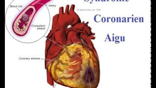 Syndrome coronarien Conduite à Tenir devant une crise cardiaque [upl. by Ahsilat984]