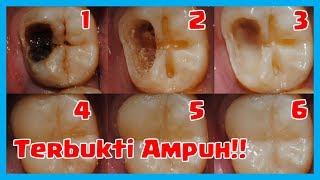 5 Cara Ampuh Mengobati Sakit Gigi Berlubang Tanpa Harus Kedokter [upl. by Lokcin]