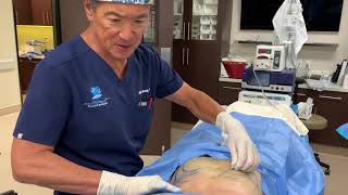 Microcannula Tumescent Liposuction Procedure [upl. by Lifton327]