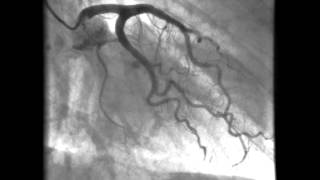 Kardiologie linkes Herzkranzgefäß  Darstellung der Kornararterien [upl. by Oswell]