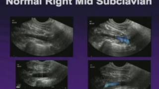 Upper Extremity Venous Exam Technique and Interpretation [upl. by Azral]