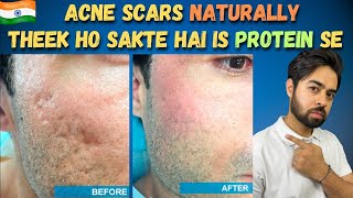 Remove Acne Scars Naturally  3 Remedies 100 Works With Results [upl. by Firehs]