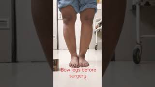 Bow legs genu varum before surgery [upl. by Merrili]