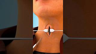 Tracheostomy Surgery Tracheostomy procedure 3D animationTracheostomy Tubeviralshortsdrsadiayt [upl. by Narf647]