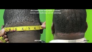 bumps back of neck razor bumps back of head Acne Keloidalis Nuchae removal changes patients life [upl. by Karla]