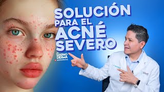 SOLUCIÓN PARA EL ACNÉ SEVERO  Consejos de un dermatólogo [upl. by Seth]