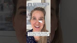 What is it like under the bandage for a mole removal mole moles moleremoval dermatology skin [upl. by Anuait]