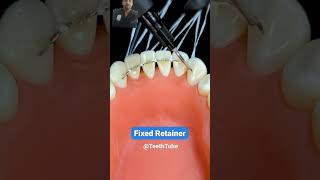 Fixed retainer viral video Target 1milne like [upl. by Kcirded]