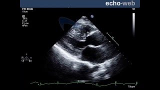 TheEchoWeb  Perimembranous Ventricular Septal Defect [upl. by Landers142]