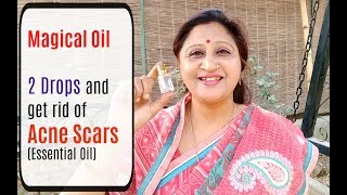 How to get rid of Acne  Pimples  Scars naturally treatment at home by Essential Oil in Hindi video [upl. by Asirram]