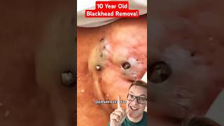 Crazy 10 Year Old BLACKHEADS REMOVAL shorts [upl. by Armalda525]