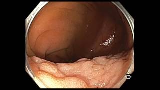 Colonoscopy IC valve and cecum flat lesion  too large lesion to resect [upl. by Apul281]