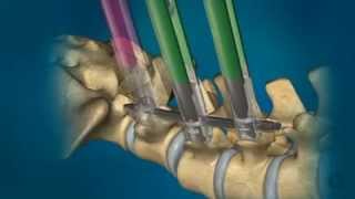 MIS Percutaneous Phoenix Screw Placement Bruce Frankel MD Charleston SC [upl. by Kcirdneked345]