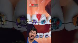 Braces Flossing Hack [upl. by Leumel]